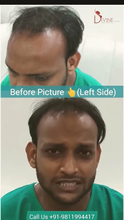 hair-fall-problem-patient-testimonial-before-hair-transplant