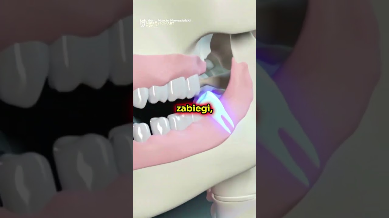 Ile Powinno Trwać Usunięcie Ósemki?