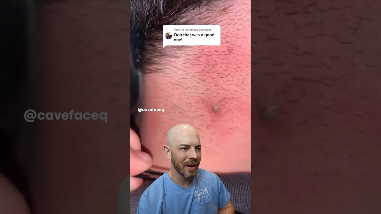 EXTREME Ingrown Hair Drreacts Ingrownhair Supersatisfying