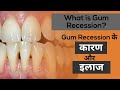 What is Gum Recession? मसूड़े नीचे जाने के कारण और उसके इलाज
