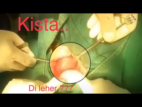 Nodul Tiroid Gejala Penyebab Sampai Pengobatan Hello Sehat