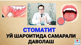 картинка: СТОМАТИТ ХАҚИДА БАФУРЖА МАЪЛУМОТ ВА УЙ ШАРОИТИДА САМАРАЛИ ДАВОЛАШ