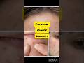 Acne se pareshan ho toh ik bar yeh try kro 👇 Amazing results 💯😱