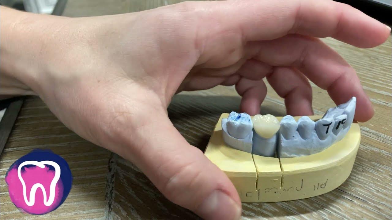 Gate City Dental How To Recement A Crown At Home YouTube