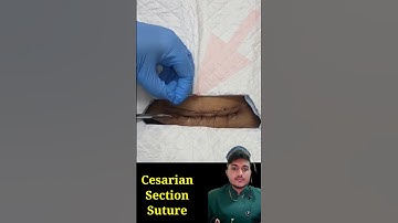 cesarian stitching #cesarian #delivery #baby #pregnancy