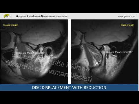 Video: Caratteristiche Istopatologiche Dell'iperplasia Condilare E Dell'osteocondroma Condilare: Uno Studio Di Confronto