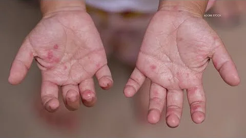 More measles cases reported in Texas: Latest data and everything we know