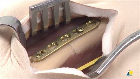 Metacarpal II - Transverse Shaft Fracture - Fixation with a 5-Hole 2.0 mm LCP