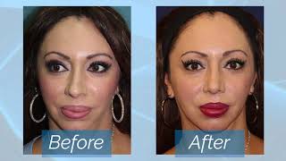 Rhinoplasty San Diego Review