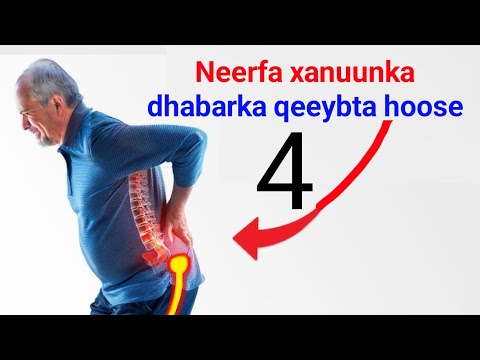 Xanuunka Neerfaha Dhabar Qeeybta Hoose 4 Qaab Oo Loo Daaweeyo Iyo Waxa Sababo