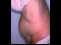 Tummy Tuck After C-Section NYC | Abdominoplasty with Dr. Bryan Forley