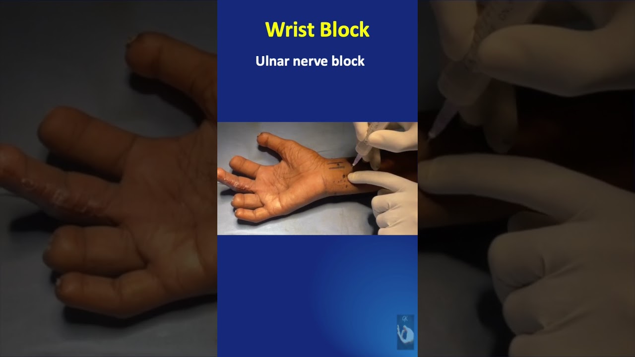 Shorts #25: Regional anaesthesia blocks: Practical wrist block - in a minute!
