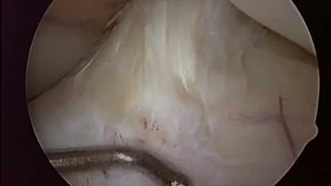 Dr. Mark Wichman - Milwaukee - Cyst Removal in Knee