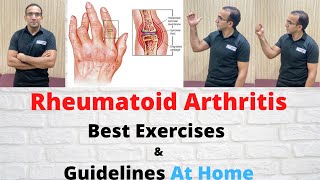 Rheumatoid Arthritis Diagnosis | Medical Treatment | Best Exercises & Guidelines | In Urdu/Hindi