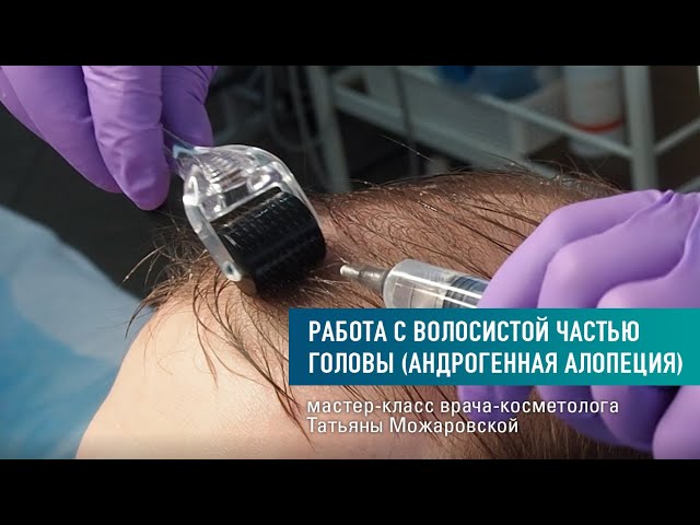 Восстановления волос при андрогенной алопеции