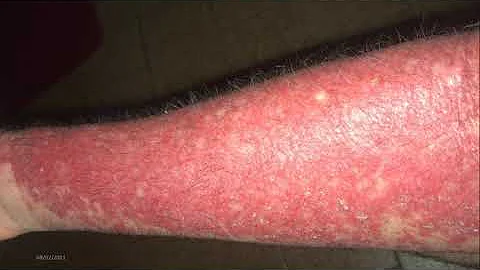 Como usar Efurix no rosto?