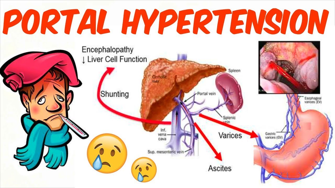 Portal Hypertension By Prof Marwa Al Emam YouTube Portal Hypertension By Prof Marwa Al Emam YouTube