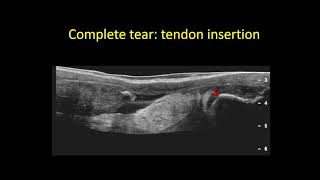 Ultrasound of Tendon Tears Ultrasound Video Lecture screenshot 5