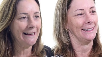 Replacing Missing Teeth with Porcelain Bridges