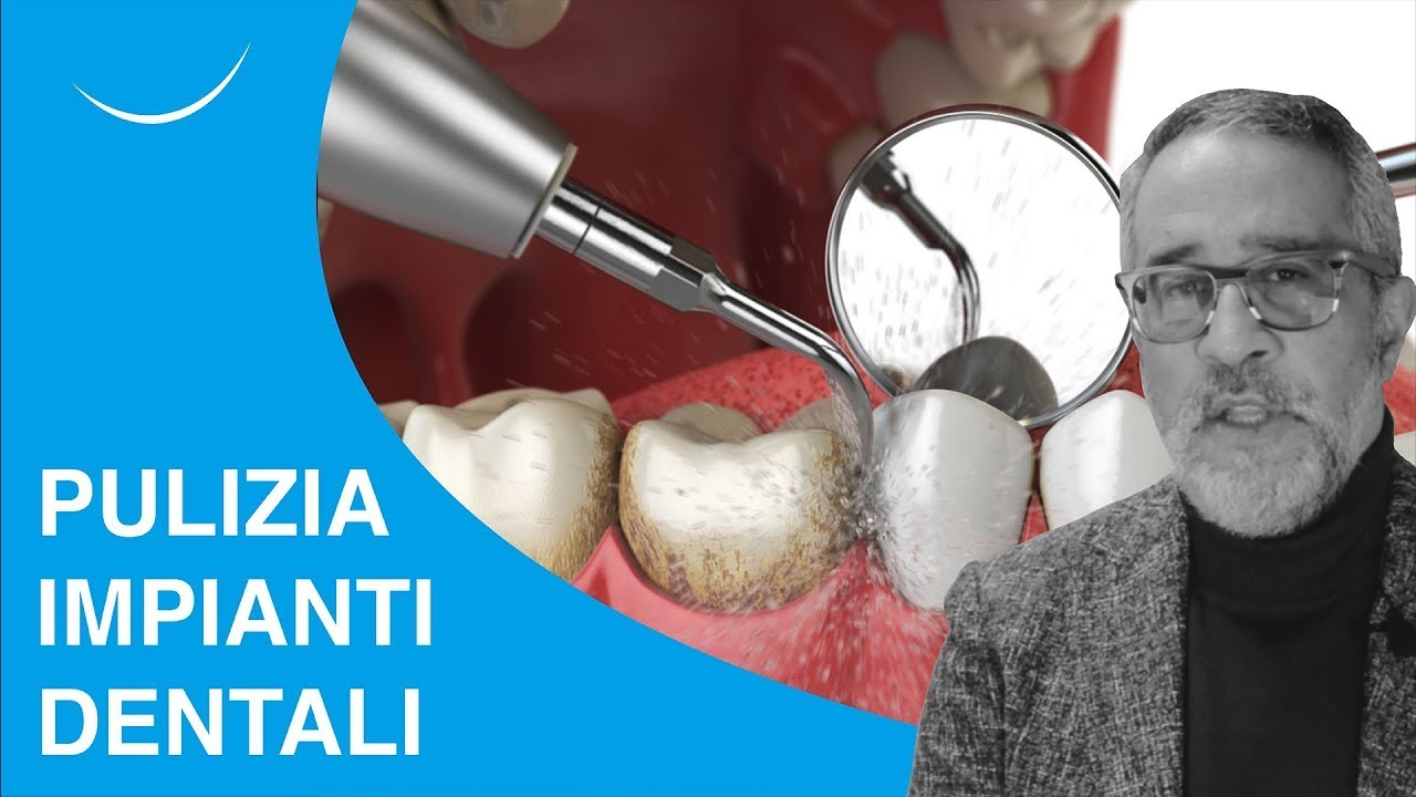 Come gli pulire impianti dentali - Prof. Makarati a Dica33 - Telearena