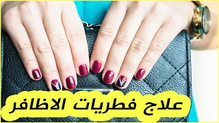 فطريات الأظافر وعلاجها  | علاج فطريات الاظافر