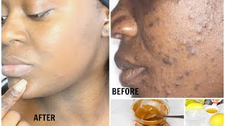 HOW TO CLEAR DARK SPOTS & HYPERPIGMENTATION FAST + CHEAP | RESULTS IN 17 DAYS