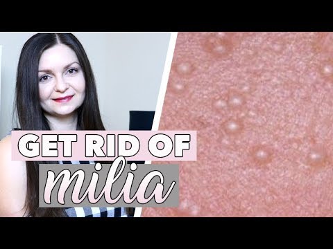 How to Get Rid of Milia - Hard White Bumps on Face - Milia Around Eyes