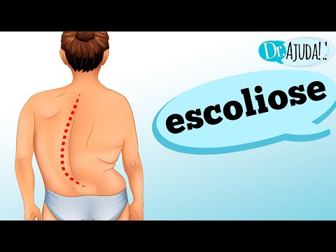 Vídeo: Como prevenir a escoliose: 7 etapas (com fotos)