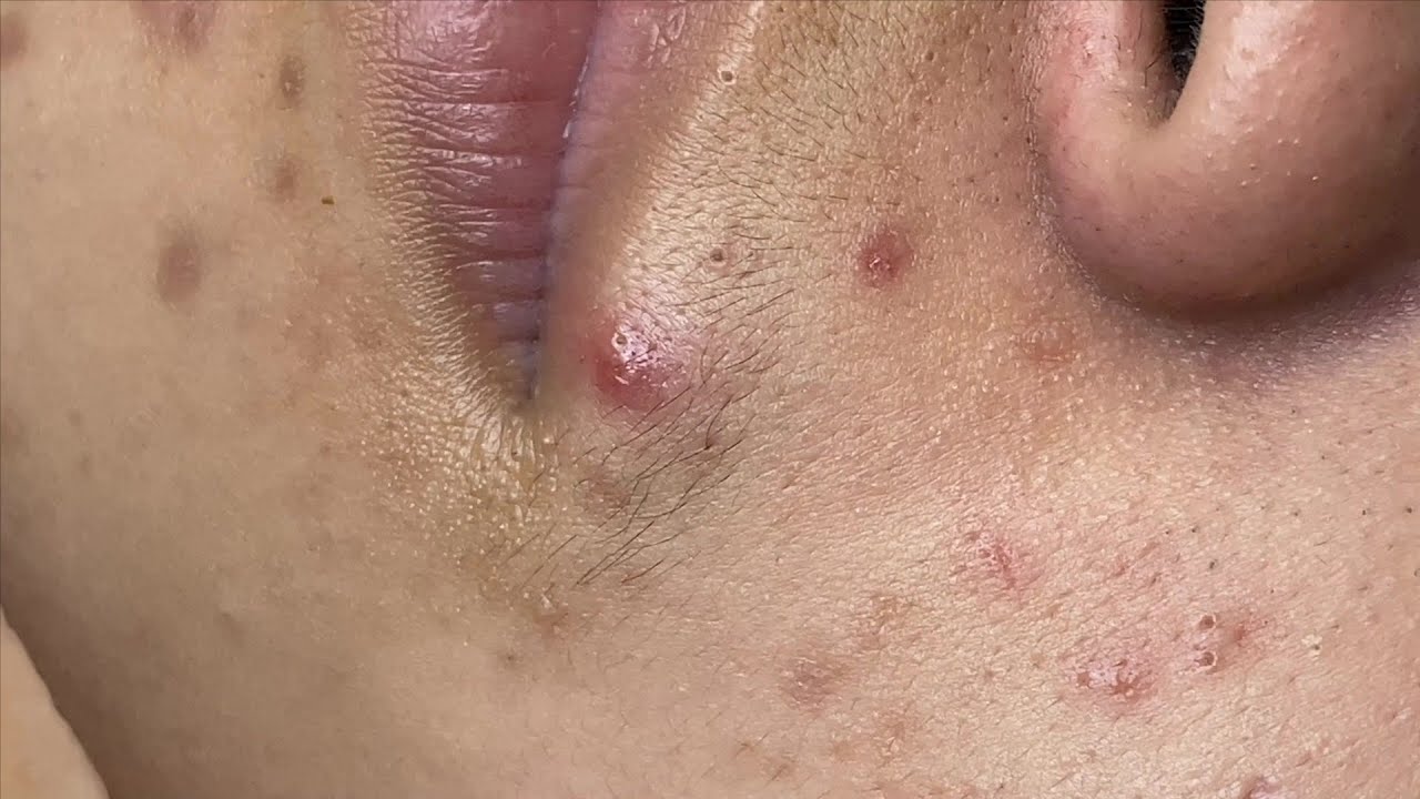 The Best Blackhead Hides Deep Under The Cleansing Skin | Mụn Đầu Đen Hay Nhất - SacDepSpa#91
