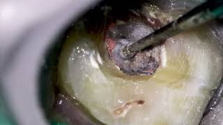 Fibre post removal from Furcation ! by Aspire32 482 views 7 months ago 58 seconds