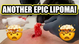 ANOTHER EPIC LIPOMA! 🤯