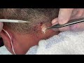 粉瘤くりぬき法 40代男性首epidermal cyst atheroma cystic acne extractions lipoma大阪心斎橋 大阪梅田院 名古屋 福岡院 神戸西宮 尼崎 奈良
