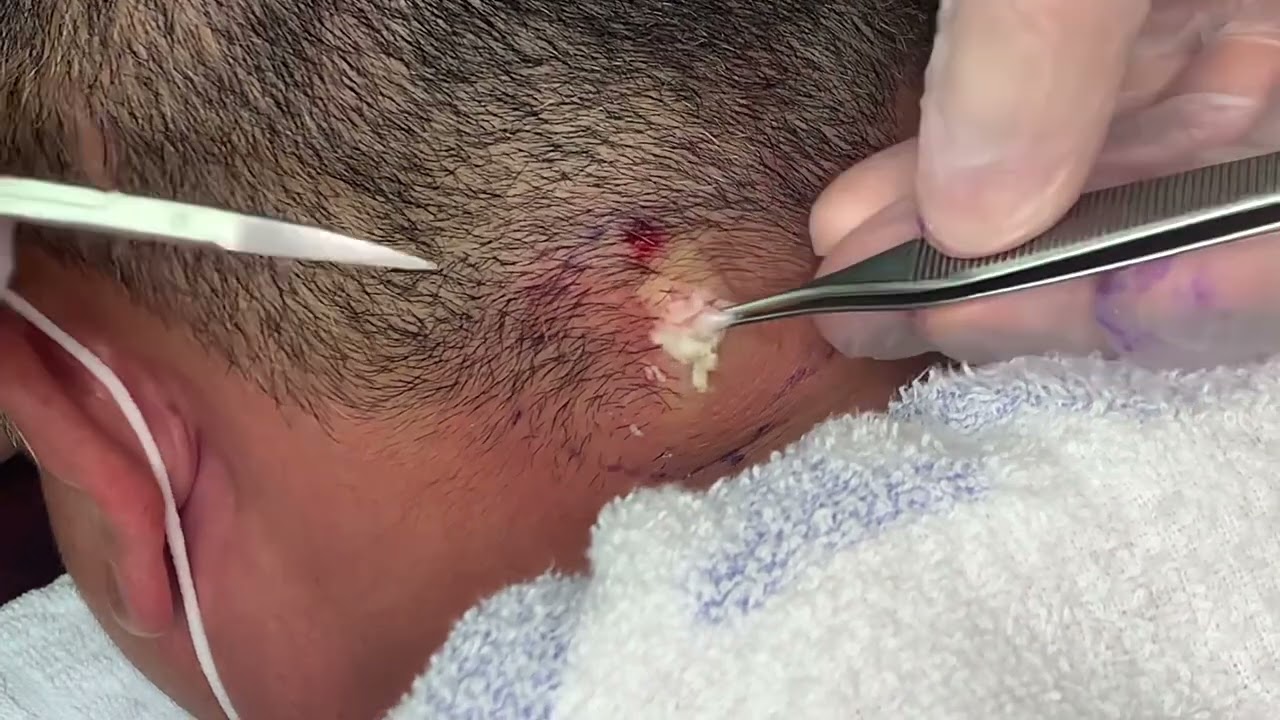 粉瘤くりぬき法 40代男性首epidermal cyst atheroma cystic acne extractions lipoma大阪心斎橋 大阪梅田院 名古屋 福岡院 神戸西宮 尼崎 奈良