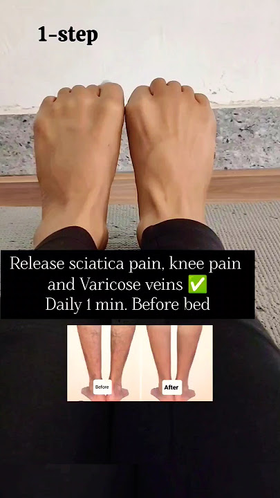 Varicose veins, back pain, sciatica pain relief ✅ #backpainrelief #sciatica #vericoseveins #exercise