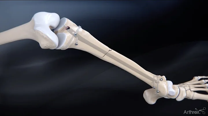Tibial Nail SystemStandard Surgical Technique