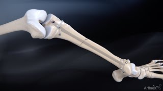 Tibial Nail System—Standard Surgical Technique