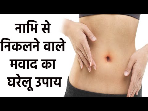 वीडियो: नाभि में संक्रमण का इलाज करने के 3 तरीके