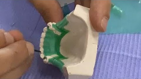 Class one Wax pattern R.P.D شرح عملى