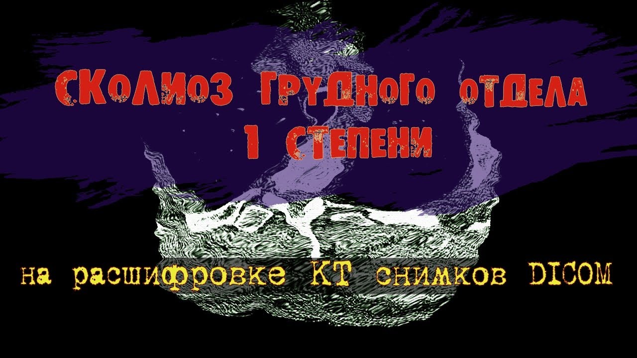 СКОЛИОЗ ГРУДНОГО ОТДЕЛА позвоночника и ГРЫЖИ пищеводного отверстия ...