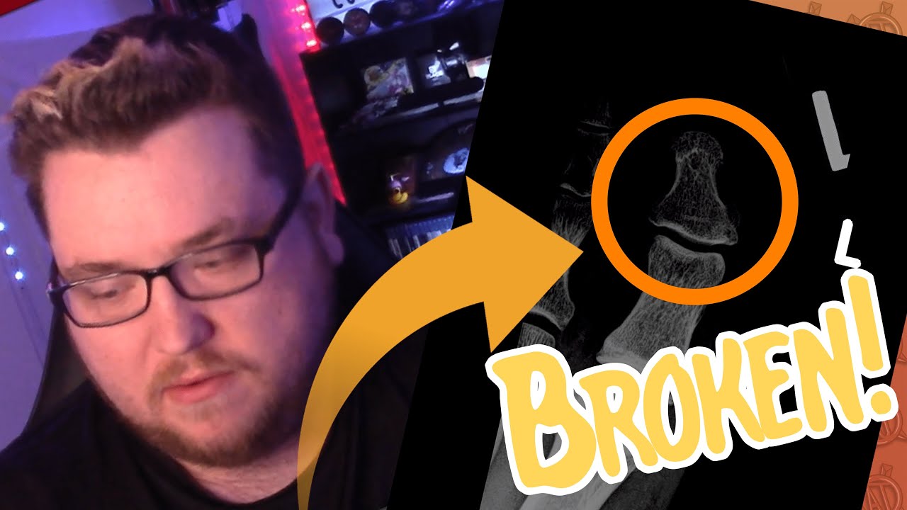 I Broke My Toe!