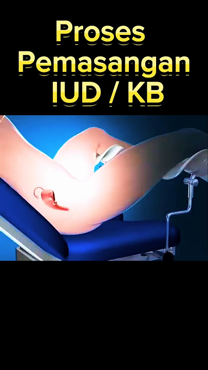 PROSES PEMASANGAN IUD/KB #kasihkisah #faktaunik #kedokteran  #iud #wanita