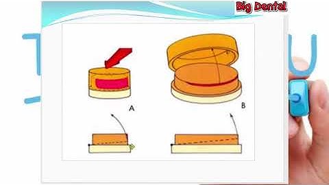 8 nguyên tắc sửa soạn cùi răng hoàn hảo(Phần 1/2)