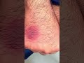 Fixed Drug Allergy