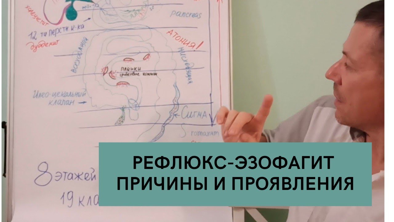 ГЭРБ. Рефлюкс-эзофагит. Недостаточность кардиального жома. #гастрит ...