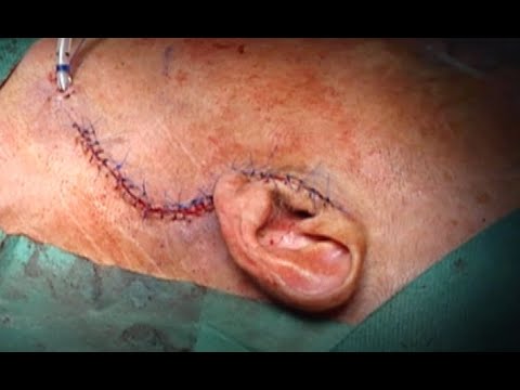 Parotidectomy