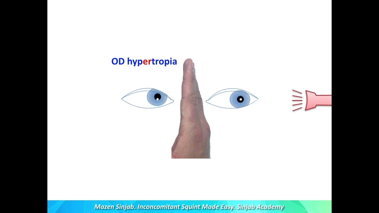 Концепции лечения косоглазия: подход, основанный на конкретных случаях: часть 1