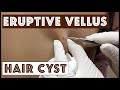 Unusual types of Cysts: Eruptive Vellus Hair Cysts, Part 1 in a Series