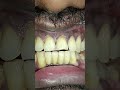 anbu laser dental clinic #dentist #dentist #dentistry #dentalartistry #dentalclinic #smiledesigndent
