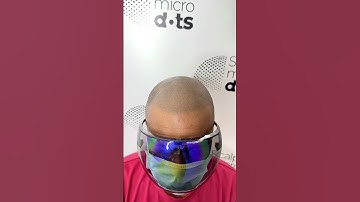 The procedure which changed many lives, SCALP MICROPIGMENRATION 🇮🇳 #smp  #scalpmicropigmentation