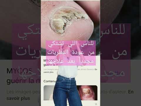 دايما تعود لي فطريات الاظافر   